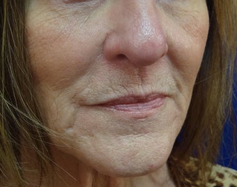 Juvederm Ultra Plus filler