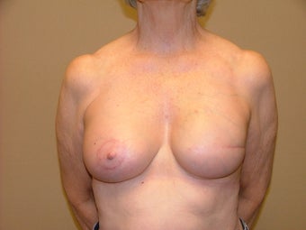 Breast Reconstruction