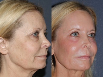 58 year old female treated with Ultra Repair Laser Resurfacing