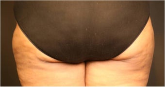 SmartLipo MPX