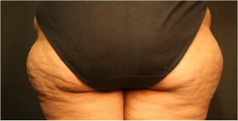 SmartLipo MPX