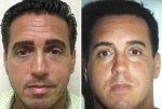 47 year old man presents with eyelid bags and loss of mid-facial volume.