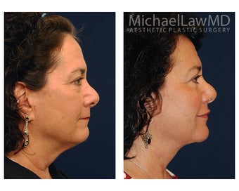 Eye Bag Surgery