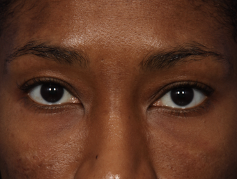 Restylane