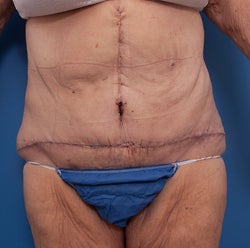 Body Lift