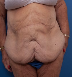 Body Lift