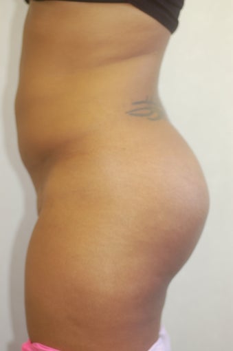 Buttock Enhancement2