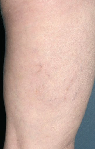 Sclerotherapy