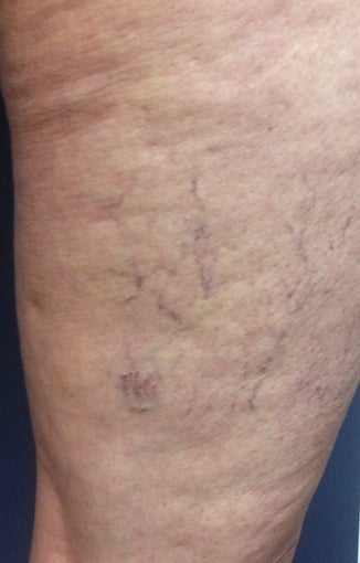 Sclerotherapy