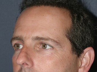 Before & After Male Botox Injections