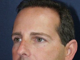 Before & After Male Botox Injections