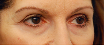 Eye Bag Surgery