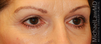 Eye Bag Surgery