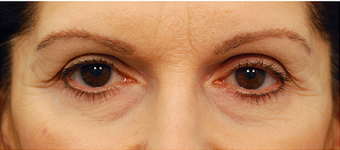 Eye Bag Surgery