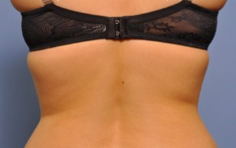 Exilis