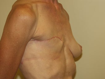Breast Reconstruction