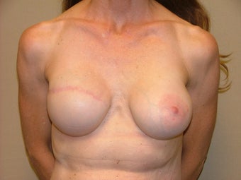 Breast Reconstruction