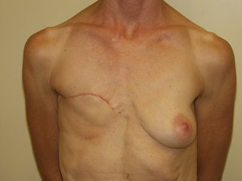 Breast Reconstruction