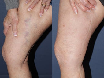 Sclerotherapy