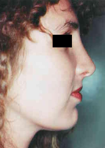 Revision Rhinoplasty