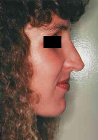 Revision Rhinoplasty