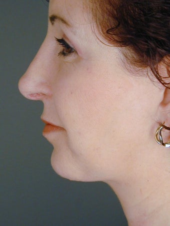 Female Chin Implant