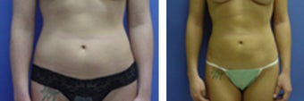Liposuction to abdomen and flanks