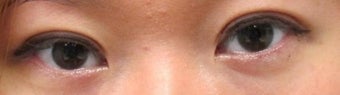 Bilateral Asian Eyelid Surgery