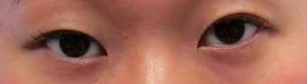 Bilateral Asian Eyelid Surgery