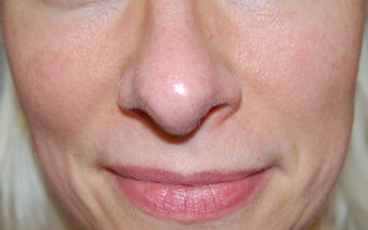 Laser treatment for facial veins and redness