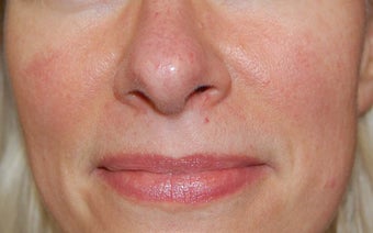 Laser treatment for facial veins and redness