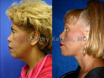 Brow and Neck Lift after massive weight loss