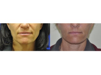 Lower Facelift/Necklift and Fat Transfer