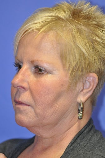 Woman, skin rejuvenation cheeks and neck
