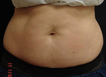 Coolsculpting Abdomen