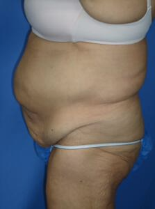 Circumferential Tuck
