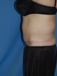 Circumferential Tuck
