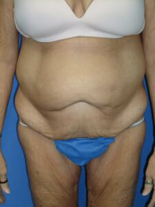 Circumferential Tuck