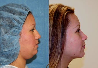 Rhinoplasty, neck liposuction, chin augmentation