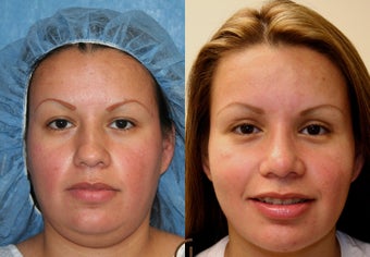 Rhinoplasty, neck liposuction, chin augmentation