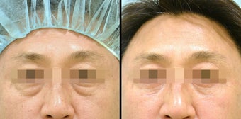 Lower Eyelid(Blepharoplasty) Surgery