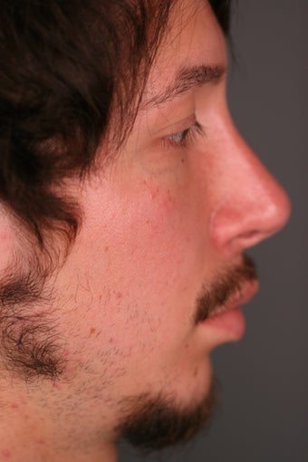 Male Chin Implant 