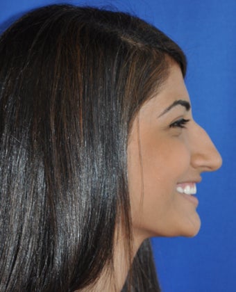 Teenage Rhinoplasty Before and Afters 