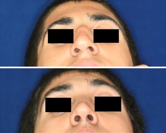 Before and after septoplatsy