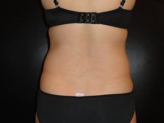 Hi-definition sculplting with Smartlipo and  "PRO-Sculpt" Formula