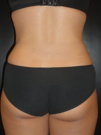 Hi-definition sculplting with Smartlipo and  "PRO-Sculpt" Formula