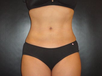 Hi-definition sculplting with Smartlipo and  "PRO-Sculpt" Formula