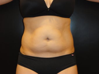 Hi-definition sculplting with Smartlipo and  "PRO-Sculpt" Formula