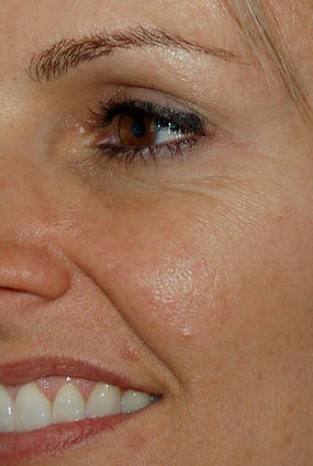 Botox Treatment