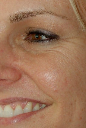 Botox Treatment